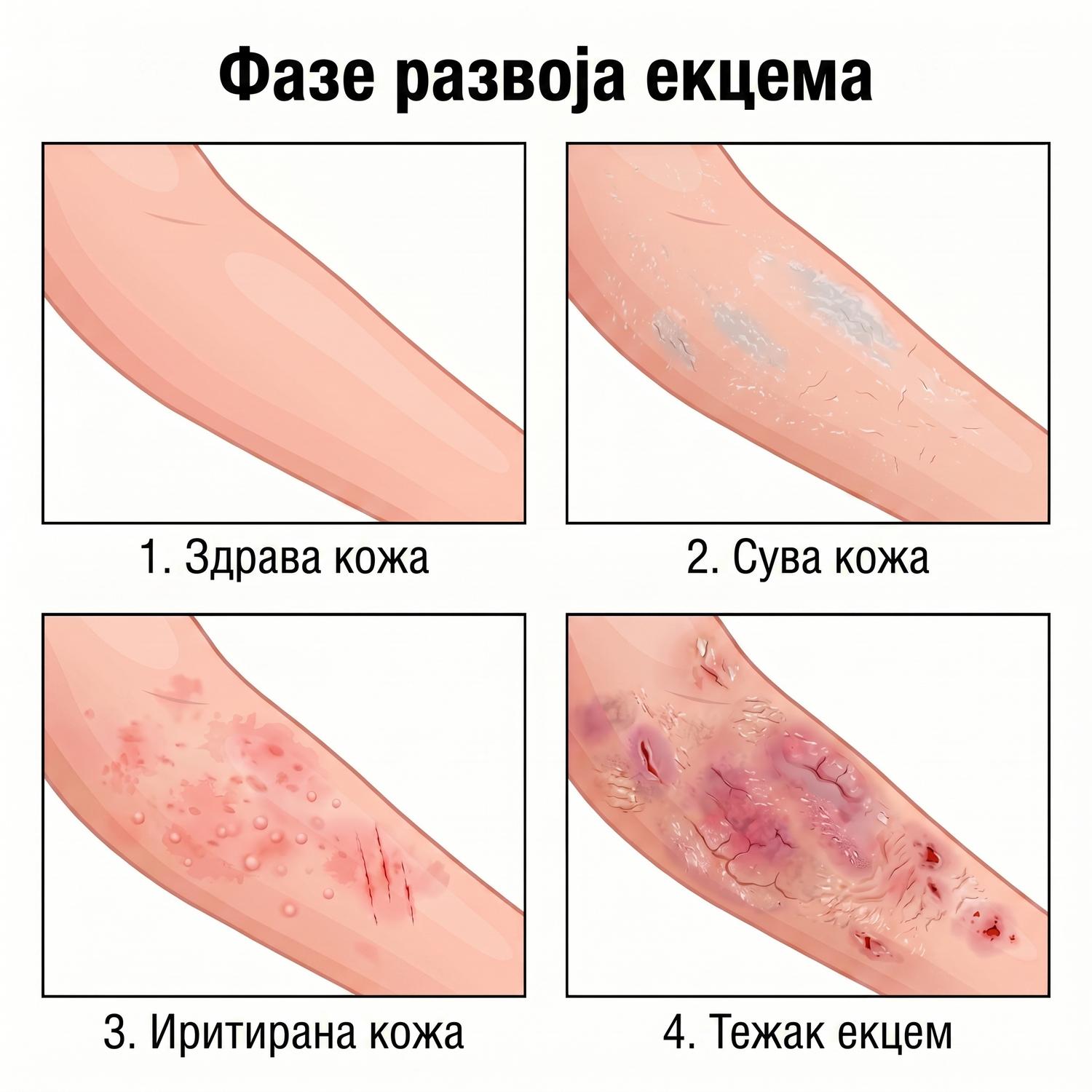 eczema_RS_eczema_4stages_v2.png