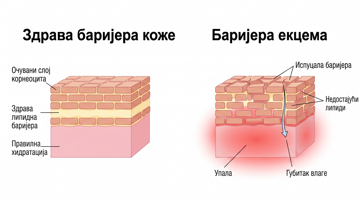 eczema_RS_skin_barrier_v2.png