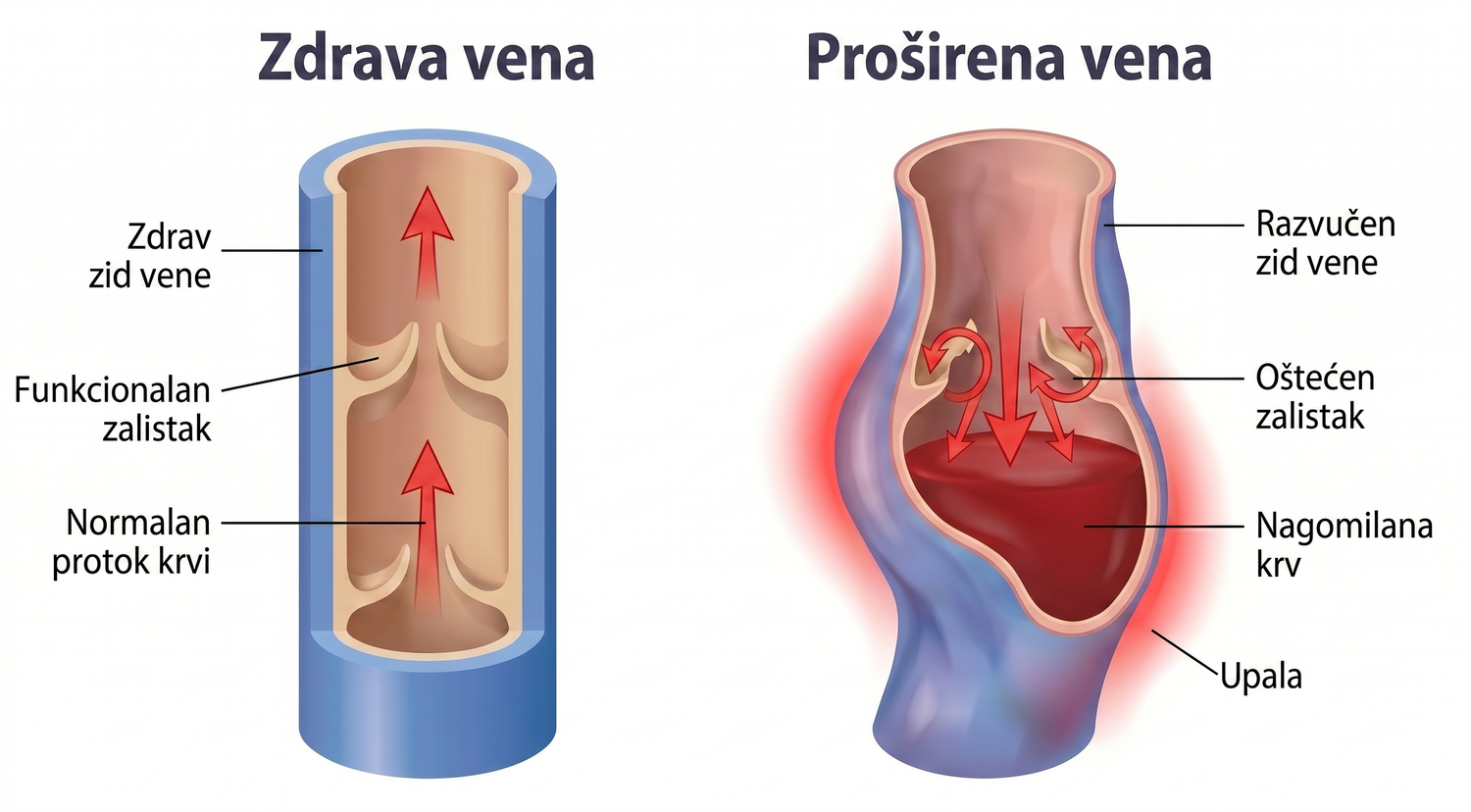 periodontis