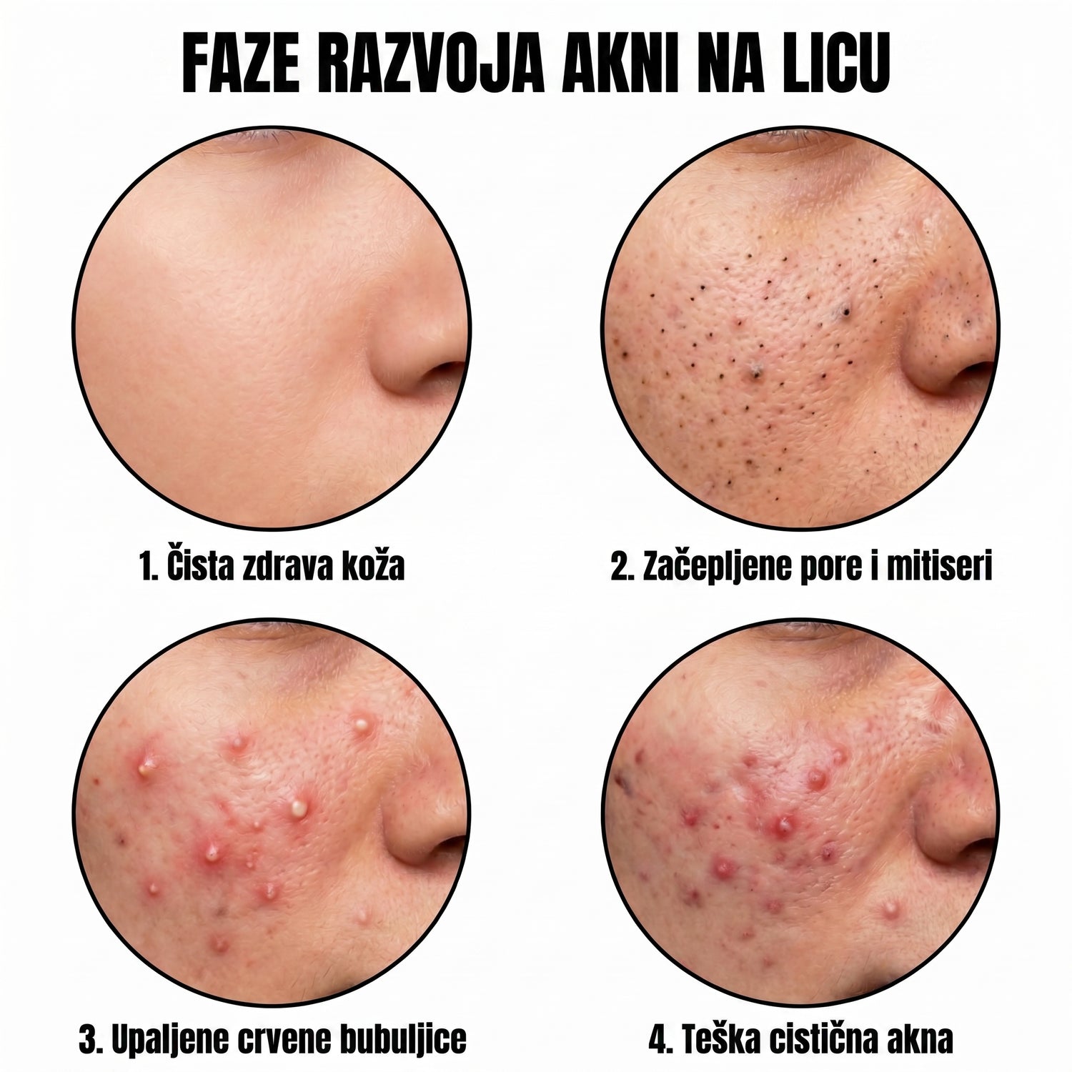 acne RS translated